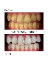 ホワイトニングショップ 岸和田店/お客様のBefore  After