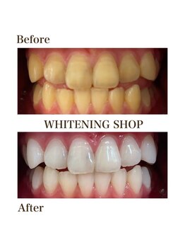 ホワイトニングショップ 岸和田店/お客様のBefore  After