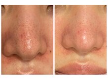 ブレス イオンタウン米沢駅前店(BLESS)/毛穴ケアもお任せください!