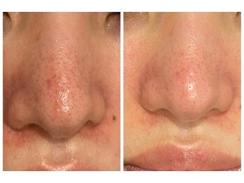 ブレス イオンタウン米沢駅前店(BLESS)/毛穴ケアもお任せください!