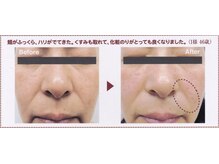 りりあす/本気で始めるシワたるみ予防！