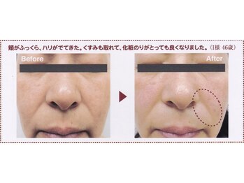 りりあす/本気で始めるシワたるみ予防!