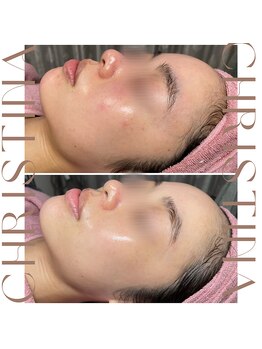 ティセラ(TISERA.)/肌の色むら/肌荒れ/赤み