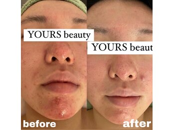 ユアーズ ビューティー(YOURS beauty)/棘あり☆１回