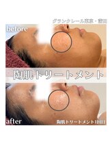 グランクレール トウキョウ(GRANDCLAIRE.TOKYO)/陶肌トリートメント