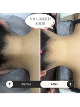 モアトゥインクル 山口店(MORE twinkle)/★症例写真★【30代】