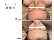 フレイヤ(FREYA)/ララピールBefore→After