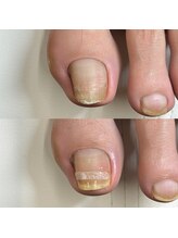 リリ(lili)/巻き爪矯正/1回目