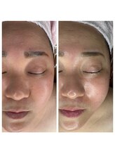 サロン ド マーシャ(salon de Marsha)/肌質の変化！