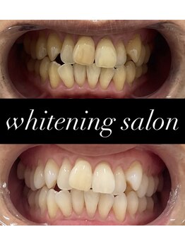 チェルト 鈴鹿店(CERTO)/短期集中美白プログラム◎