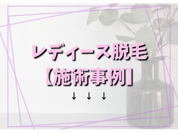 キュー(cue)/レディース脱毛【施術事例】