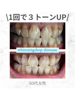 ホワイトニングショップ 島根店/Before&After美白ホワイトニング