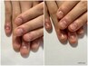 【女性/ハンド】見た目を徹底改善！深爪矯正コース/体験¥23,100→