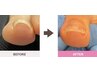【巻き爪矯正】歩くと痛い…そんなお悩みに◎丁寧ケアで快適サポート