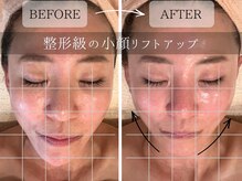 浮腫んだ顔、加齢による皮膚のタルミや筋肉の弱化もスッキリ艶肌