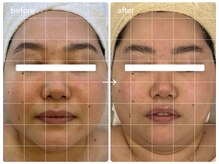 ナポデイズ(NAPODAYS)/小顔ケア（パワーレメディ）