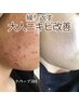 【赤み・乾燥・大人ニキビ改善】隠すメイクからノーファンデ艶肌へ★