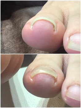 モアクリスタル(More Crystal)/巻き爪補正