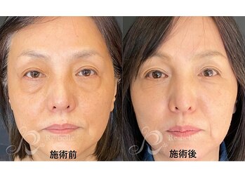 ベルメイク(BELLE MAKE)/リベル☆ビフォーアフター