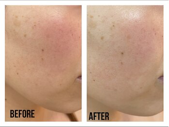 ザ ワン(THE ONE)/小顔/赤ら顔/シミ改善 ハーブ