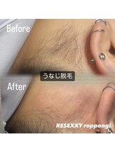 リゼクシー INTERNATIONAL麻布十番 六本木(RESEXXY)/うなじの脱毛