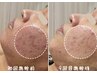 【ハーブピーリング 】陶肌トリートメント☆ニキビのケア付き 約60分 ¥9,900