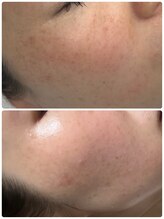 リカルム(Recalme)/ピーリング3回目