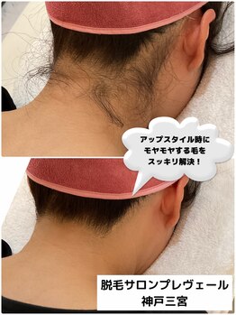 プレヴェール 神戸三宮/うなじ脱毛
