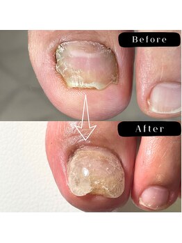 まき爪晴れる/前に伸びない爪