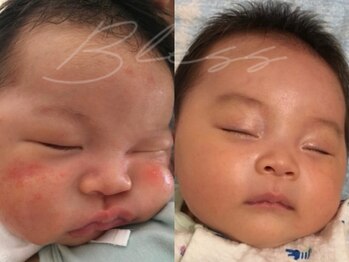 ブレス/Before→After