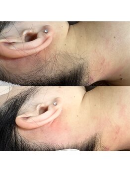 ルピナス(Lupinus)/うなじwax脱毛