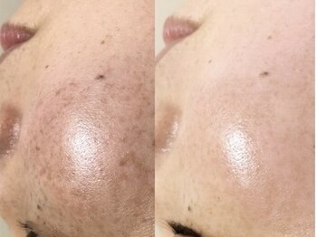 ヴィヴァンビー(Vivant+B)/before/after