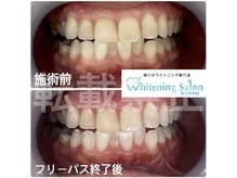 ホワイトニングサロン 福岡天神店/ホワイトニング