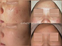 エステティックホドキ(esthetic HODOKI)の雰囲気（ニキビケア｜いつまでも悩ませない。肌知識・経験で本物の結果を）