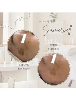 セメヴェール(Saimervell)/シミの根本から改善しましょう☆