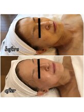 ヒダマリ(HIDAMARI)/毛穴エクストラクション◆