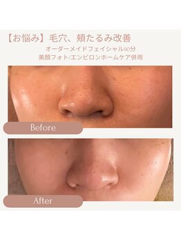 プリマジュール/頬のたるみ、毛穴たるみ改善