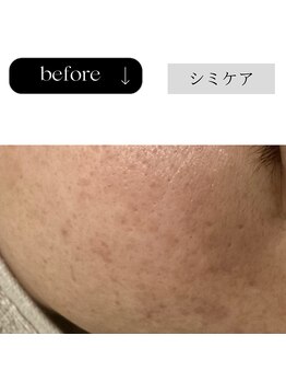 チューズ 北参道 代々木店(CHOOSE)/1回でもスキントーンUP↑UP↑