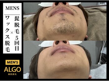 アルゴ 小倉守恒店(ALGO)/髭脱毛