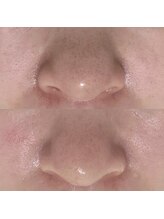 ハーナウ ハウ(hanau hou)/ハーブピーリング効果