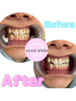 エクシアホワイトニング 札幌駅前店/セルフホワイトニング☆