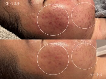 シェステ ゴジュウヨン(shesthe54)/症例写真｜ニキビケア