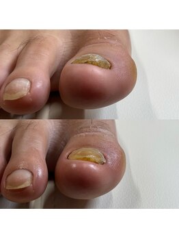 リリ(lili)/巻き爪矯正/1回目