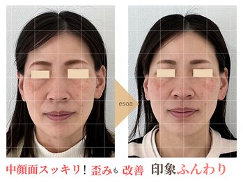 エソア(esoa)/40代 小顔矯正