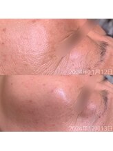 &still【アンドスティル】【4/1 NEW OPEN（予定）】 /【ホワイトスノーピール】１ヶ月