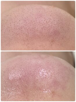 プアラ(puala)/ビフォーアフター