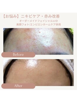 プリマジュール/ニキビケア（オーダーメイドF）