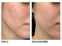 オーシャンブルー 福岡店(OCEAN BLUE フェイシャル&ボディ)/ニキビケア(グロウパールピール)