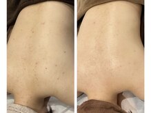 ベベアート(BEBEART)/背中REVI陶肌ハーブピーリング