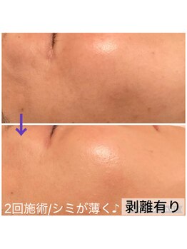 お気軽ビューティエーヴィヒ(Ewig)/当日相談可◆ハーブピーリング◆